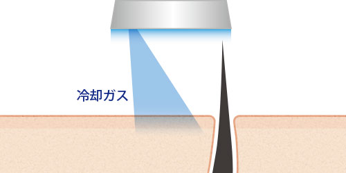 痛みを緩和する最新脱毛機器